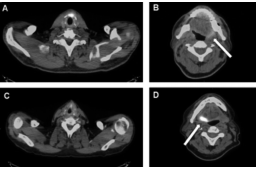 The impact of direct laryngoscopy on PET/CT scan results in newly diagnosed head and neck cancer