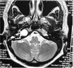 Endoscopic-assisted exenteration of massive petrous apex cholesteatoma misdiagnosed as Bell’s Palsy