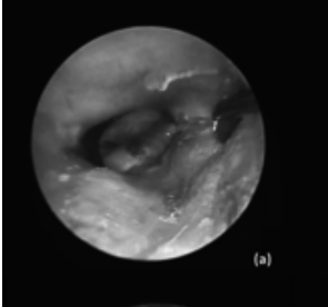 Endoscopic stapes surgery: our clinical experience and learning curve