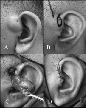 Experiences with the surgical management of preauricular sinus