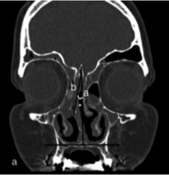 Impact of high septal deviation in the success of frontal sinus surgery