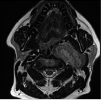 Catecholamine-producing vagal paraganglioma: a case report