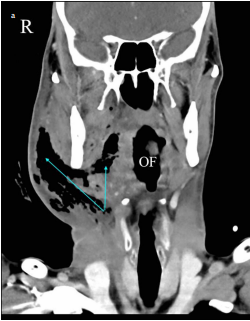 A case of necrotizing fasciitis mimicking an abscess in the deep neck space